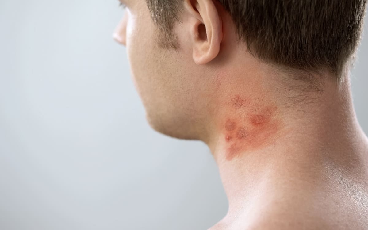 A man with dermatitis on his neck