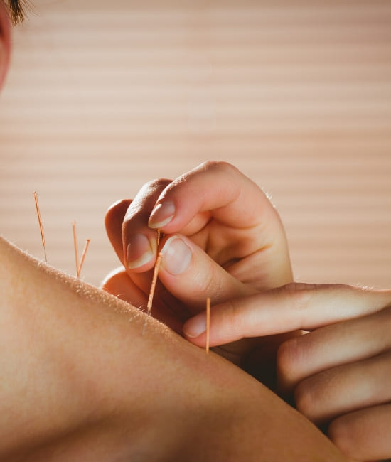 The shoulder of a man as an acupuncturist places needles on it as part of an acupuncturist treatment